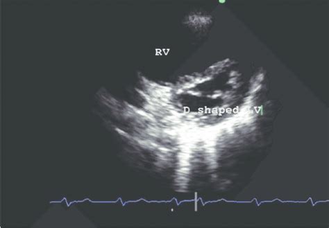 d shaped lv cavity